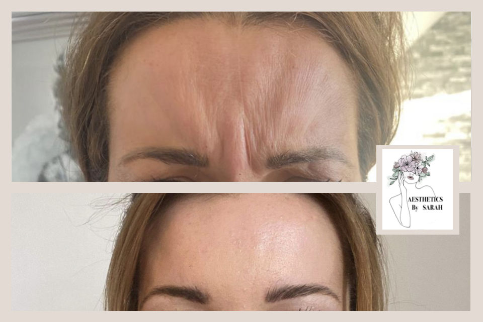 Aesthetics by Sarah - Botox anti-wrinkle injections