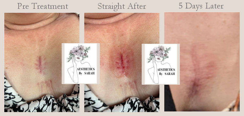 Aesthetics by Sarah - Microneedling
